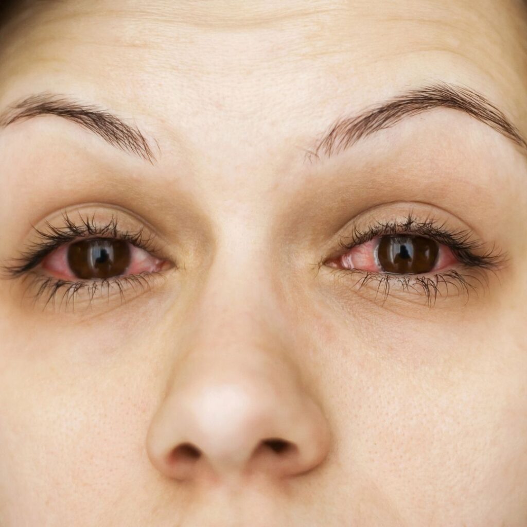 Woman with irritated eyes